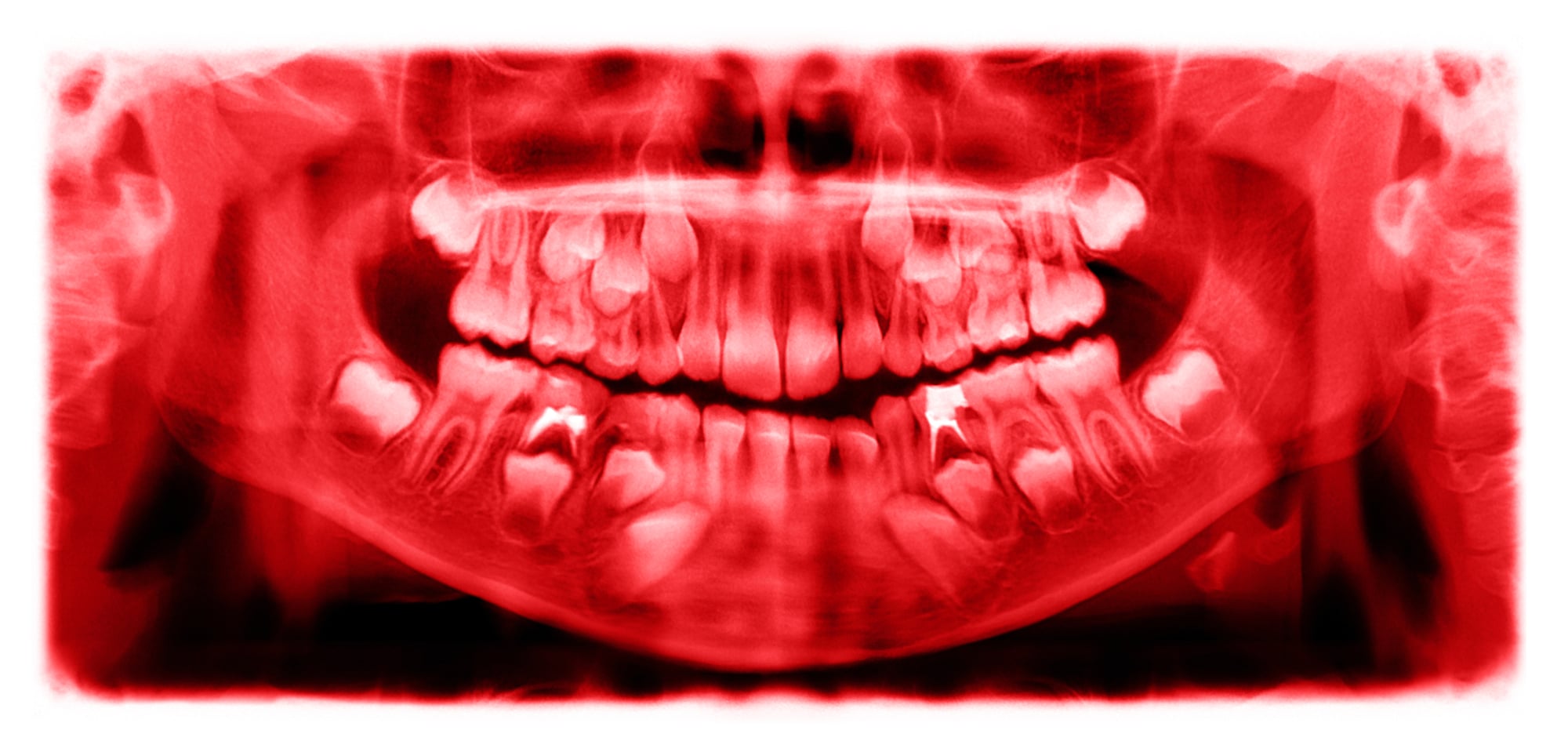 Panoramic radiograph is a scanning dental X-ray of the upper jaw maxilla and lower jawbone mandible a child aged 7 seven years. This image is colored in shades of red.